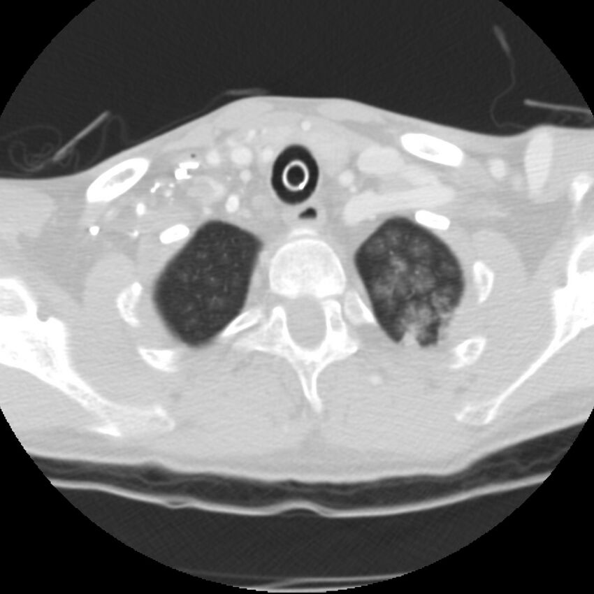 Acute diffuse alveolar hemorrhage (Radiopaedia 41323-44158 Axial lung window 1).jpg