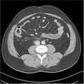 Acute pancreatitis - mild (Radiopaedia 27796-28033 C+ portal venous phase 34).jpg