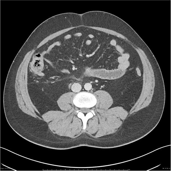 File:Acute pancreatitis - mild (Radiopaedia 27796-28033 C+ portal venous phase 34).jpg