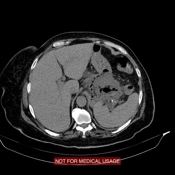File:Acute pancreatitis with infected necrosis (Radiopaedia 26454-26585 Axial non-contrast 4).jpg