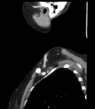 Acute parotitis (Radiopaedia 27425-27619 Sagittal C+ portal venous phase 51).png