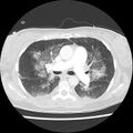 Acute pulmonary edema on CT (Radiopaedia 33582-34672 Axial lung window 21).jpg