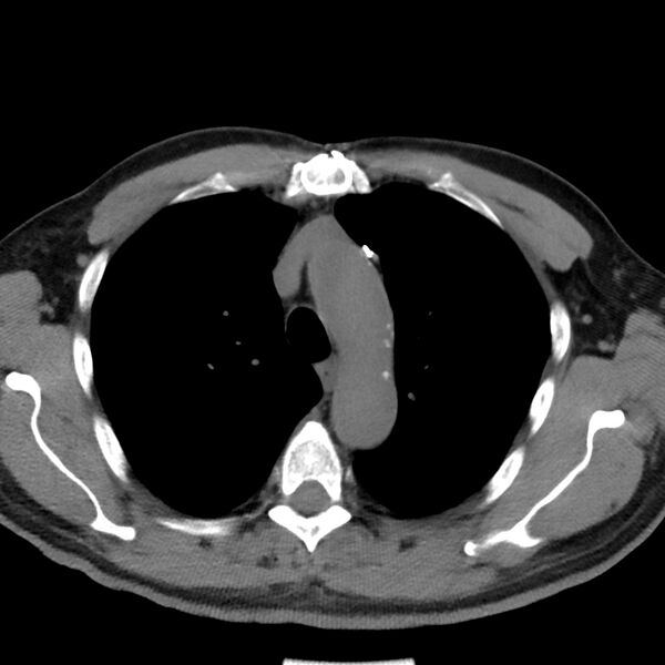 File:Acute pulmonary embolism (Radiopaedia 81677-95570 Axial non-contrast 5).jpg