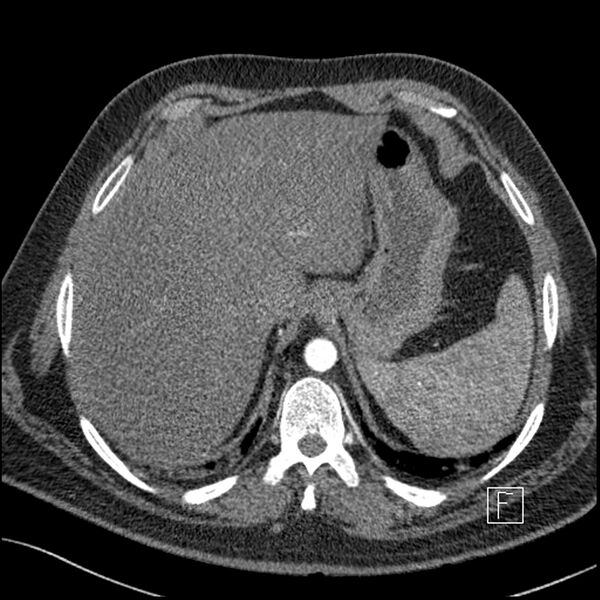 File:Acute pulmonary embolism with pulmonary infarct (Radiopaedia 73062-83768 Axial C+ CTPA 71).jpg