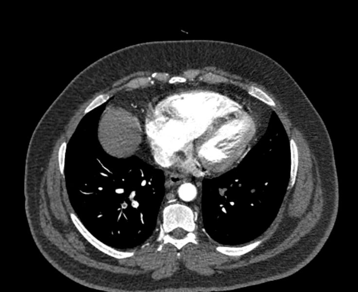 File:Acute pulmonary embolism with pulmonary infarcts (Radiopaedia 77688-89908 Axial C+ CTPA 46).jpg