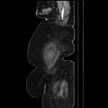 Acute pyelonephritis (Radiopaedia 25657-25837 Sagittal renal parenchymal phase 12).jpg