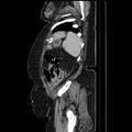 Acute pyelonephritis (Radiopaedia 25657-25837 Sagittal renal parenchymal phase 66).jpg