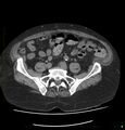 Acute renal failure post IV contrast injection- CT findings (Radiopaedia 47815-52557 Axial non-contrast 58).jpg