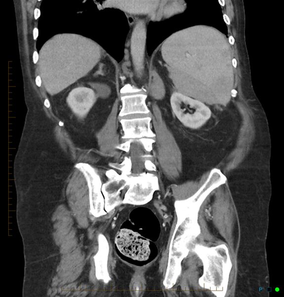 File:Acute renal failure post IV contrast injection- CT findings (Radiopaedia 47815-52559 Coronal C+ portal venous phase 23).jpg