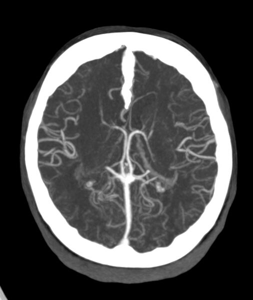 File:Acute right MCA M1 occlusion (Radiopaedia 62268-70454 Axial Phase 2 13).jpg