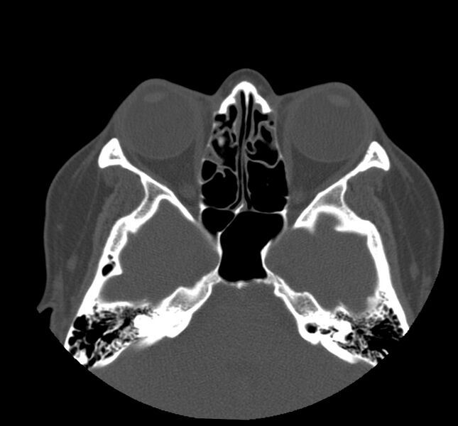 File:Acute sinusitis (Radiopaedia 22419-22455 Axial non-contrast 20).jpg