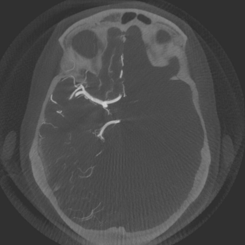 Acute subarachnoid hemorrhage and accessory anterior cerebral artery (Radiopaedia 69231-79010 Axial arterial - MIP 30).jpg