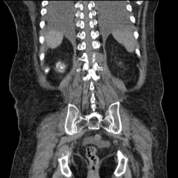 File:Acute tubular necrosis (Radiopaedia 28077-28334 G 66).jpg