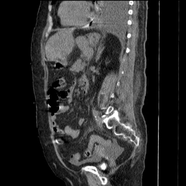 File:Acute tubular necrosis (Radiopaedia 28077-28334 Sagittal non-contrast 55).jpg