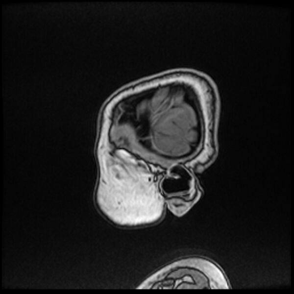File:Adamantinomatous craniopharyngioma (Radiopaedia 77407-89529 Sagittal T1 C+ 9).jpg