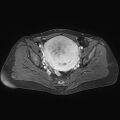 Adenomyoma of the uterus (huge) (Radiopaedia 9870-10438 Axial T1 C+ fat sat 16).jpg
