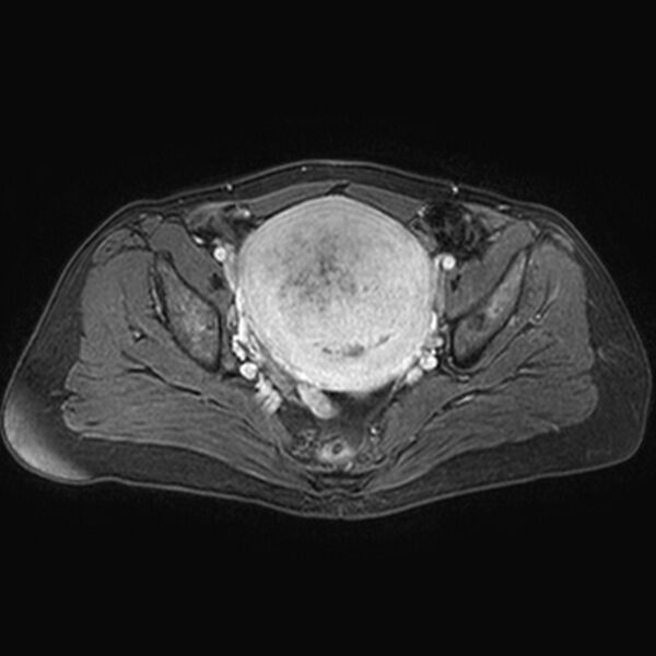 File:Adenomyoma of the uterus (huge) (Radiopaedia 9870-10438 Axial T1 C+ fat sat 16).jpg
