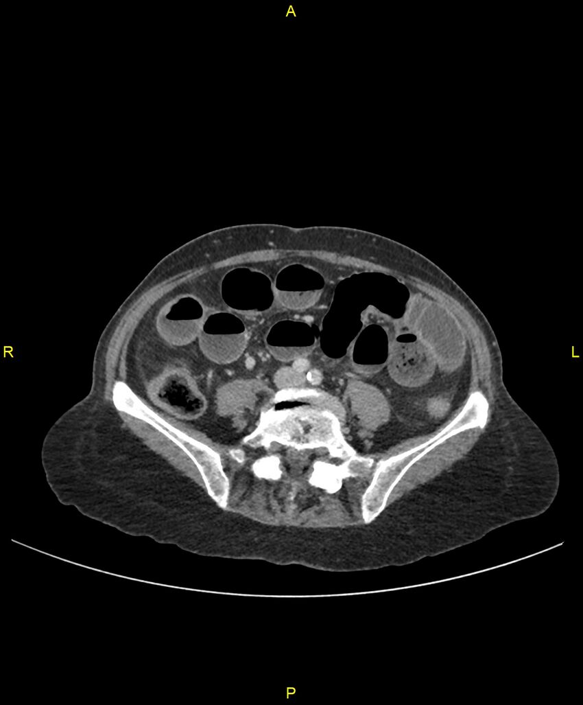 Adhesional small bowel obstruction (Radiopaedia 85402-101024 Axial C+ portal venous phase 181).jpg