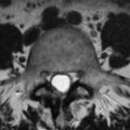 Adhesive arachnoiditis - empty thecal sac sign (Radiopaedia 25838-25987 Axial T2 6).jpg