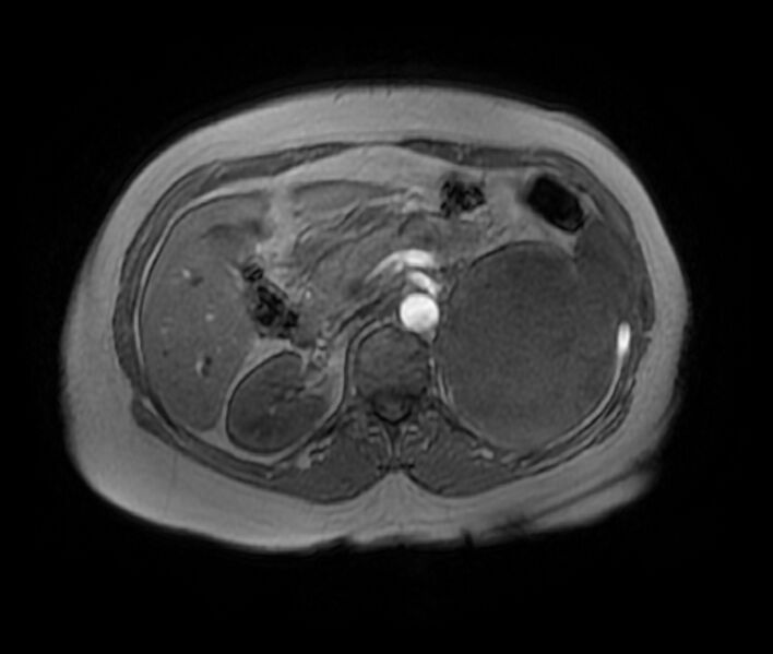 File:Adrenal cortical carcinoma (Radiopaedia 70906-81116 Axial T1 in-phase-out-of-phase 18).jpg