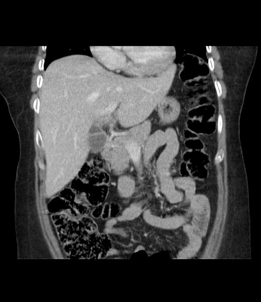 File:Adrenal cortical carcinoma with IVC invasion and thrombosis (Radiopaedia 34307-35597 Coronal C+ portal venous phase 21).jpg