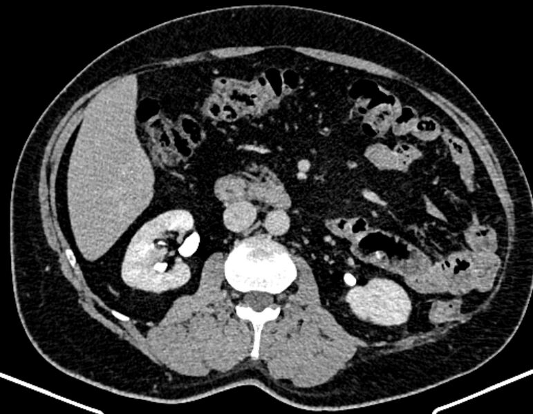 File:Adrenal metastases (Radiopaedia 73082-83791 Axial C+ delayed 157).jpg