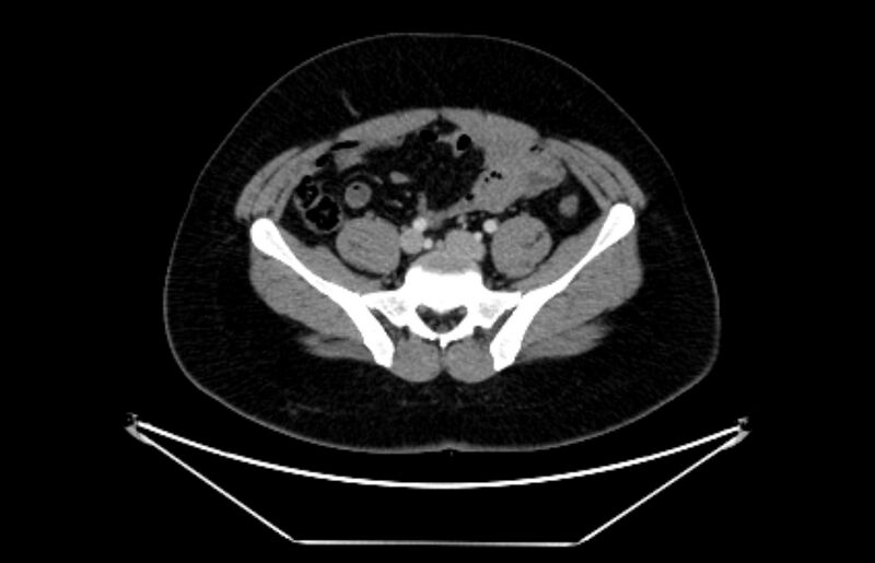 File:Adrenocortical carcinoma (Radiopaedia 80134-93438 Axial C+ portal venous phase 95).jpg