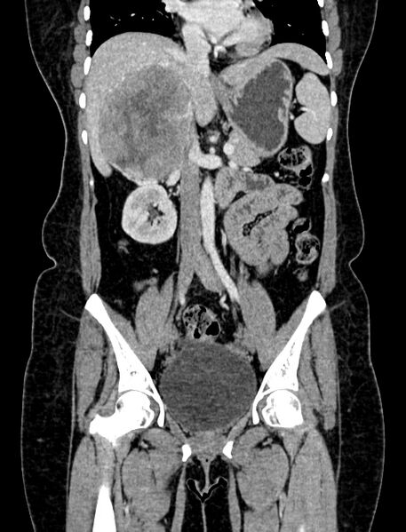 File:Adrenocortical carcinoma (Radiopaedia 87281-103569 Coronal C+ portal venous phase 44).jpg