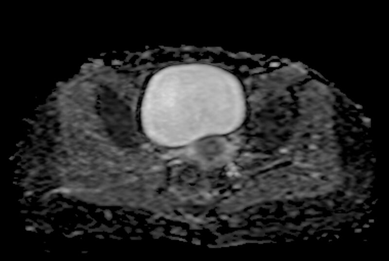 File:Adult granulosa cell tumor of the ovary (Radiopaedia 71581-81950 Axial ADC 17).jpg