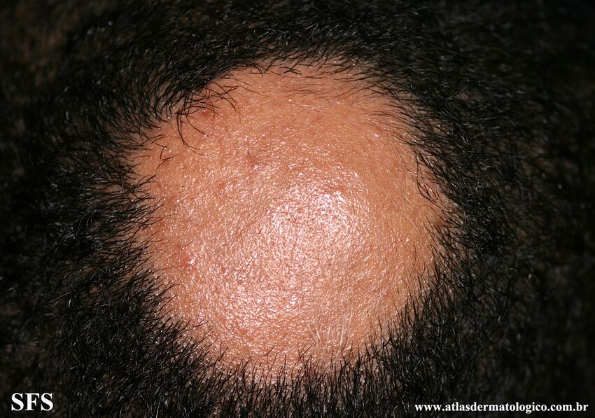 Alopecia Areata (Dermatology Atlas 71).jpg