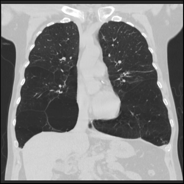 File:Alpha-1-antitrypsin deficiency (Radiopaedia 40993-43722 Coronal lung window 40).jpg