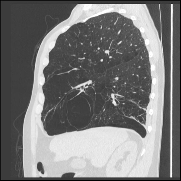 File:Alpha-1-antitrypsin deficiency (Radiopaedia 40993-43722 Sagittal lung window 186).jpg