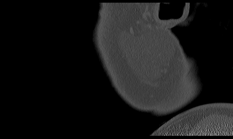 File:Ameloblastoma (Radiopaedia 33677-34806 Sagittal bone window 6).png