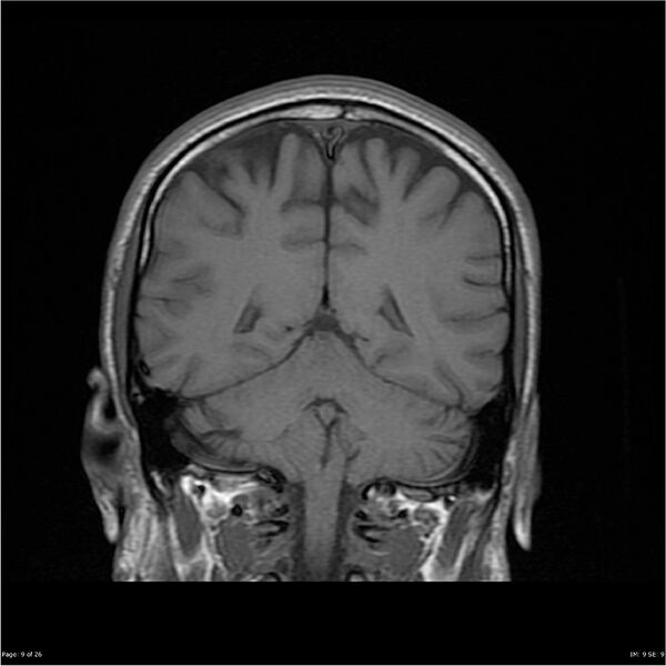 File:Amnestic syndrome secondary to hypoxic brain injury (Radiopaedia 24743-25004 B 9).jpg