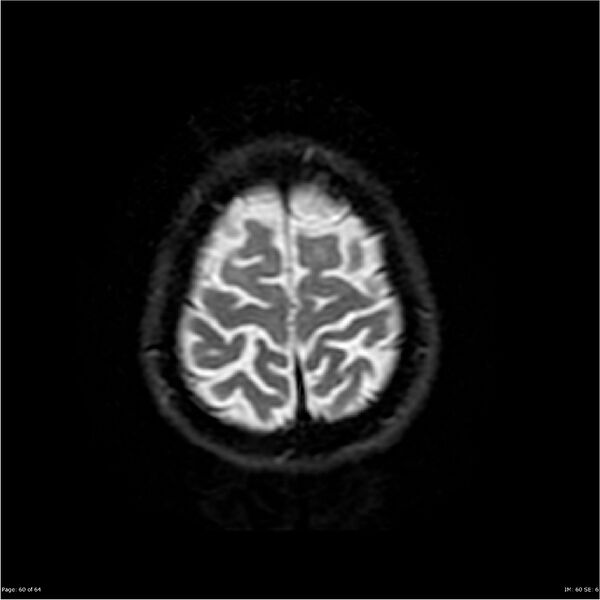 File:Amnestic syndrome secondary to hypoxic brain injury (Radiopaedia 24743-25004 DWI 60).jpg