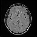 Amnestic syndrome secondary to hypoxic brain injury (Radiopaedia 24743-25004 FLAIR 11).jpg