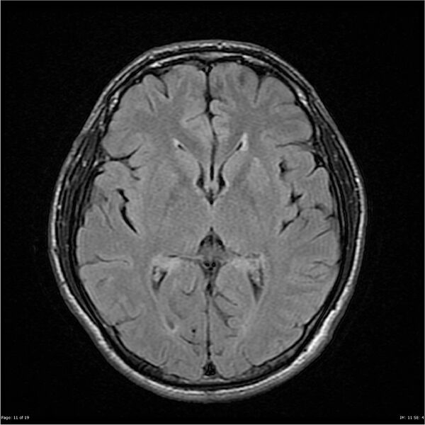 File:Amnestic syndrome secondary to hypoxic brain injury (Radiopaedia 24743-25004 FLAIR 11).jpg