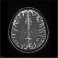 Amnestic syndrome secondary to hypoxic brain injury (Radiopaedia 24743-25004 T2 15).jpg
