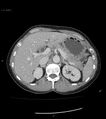 Ampulla of Vater metastasis (Radiopaedia 27820-28069 A 8).jpg
