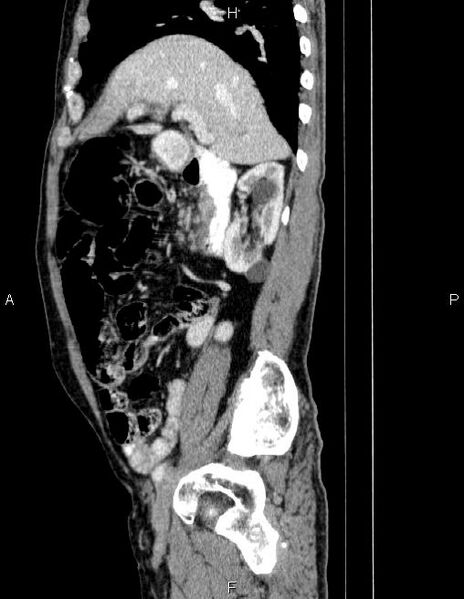 File:Ampullary adenocarcinoma (Radiopaedia 86093-102032 D 30).jpg