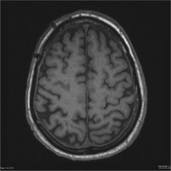 File:Anaplastic meningioma with recurrence (Radiopaedia 34452-35788 Axial T1 110).jpg