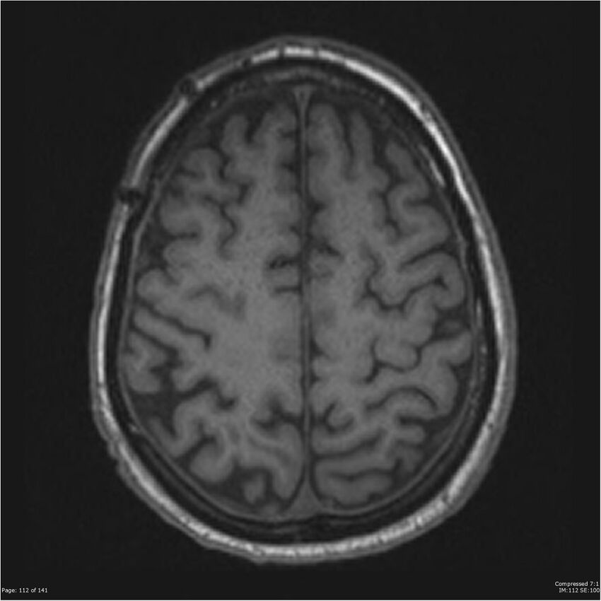 Anaplastic meningioma with recurrence (Radiopaedia 34452-35788 Axial T1 110).jpg
