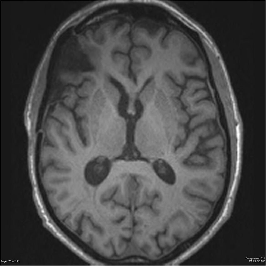 Anaplastic meningioma with recurrence (Radiopaedia 34452-35788 Axial T1 71).jpg