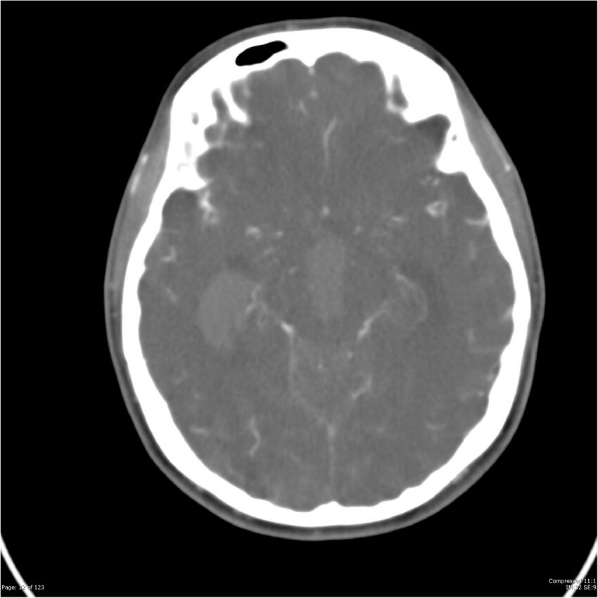 Aneurysmal subarachnoid hemorrhage and Moya Moya disease (Radiopaedia 34306-35593 Axial CT COW 32).jpg