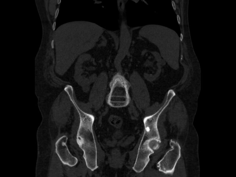 File:Ankylosing spondylitis (Radiopaedia 44609-48357 Coronal bone window 44).jpg