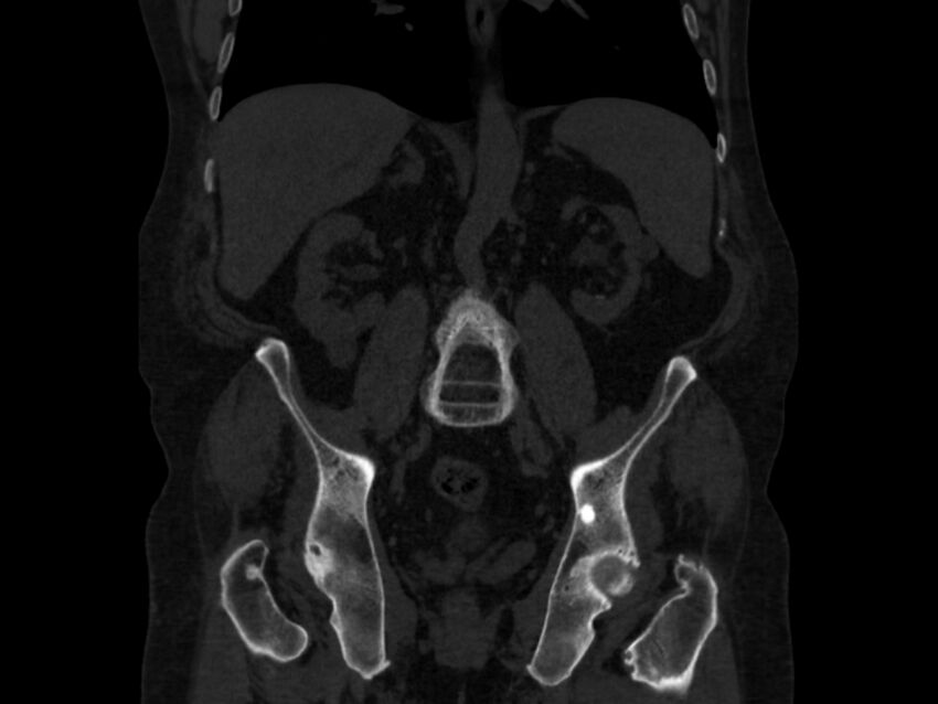 Ankylosing spondylitis (Radiopaedia 44609-48357 Coronal bone window 44).jpg