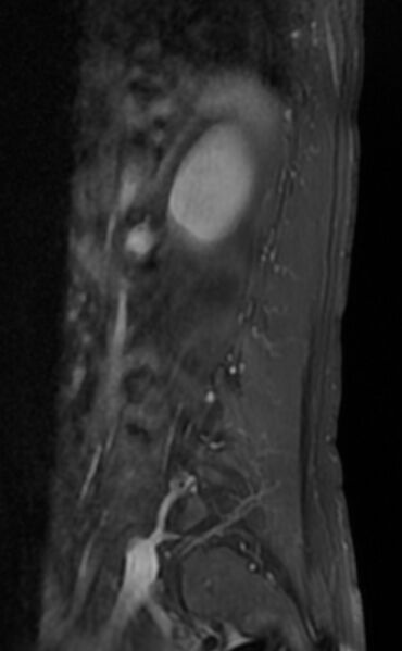 File:Ankylosing spondylitis - Andersson lesion (Radiopaedia 81878-95838 F 12).jpg