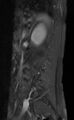 Ankylosing spondylitis - Andersson lesion (Radiopaedia 81878-95838 F 12).jpg