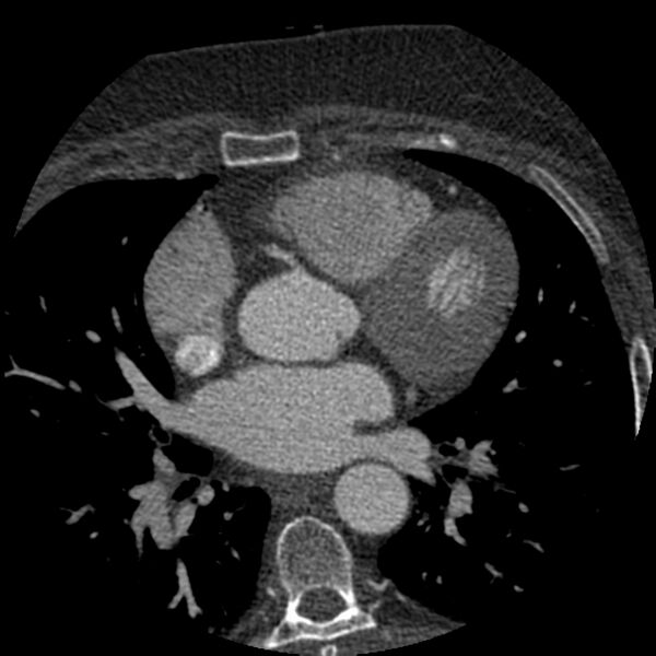 File:Anomalous origin of left circumflex artery from right coronary sinus (Radiopaedia 72563-83117 B 55).jpg