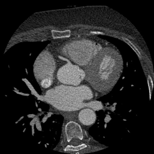 File:Anomalous origin of left circumflex artery from right coronary sinus (Radiopaedia 72563-83117 B 58).jpg